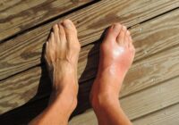 New Treatment Approach for Gout in Specific Patients Discovered
