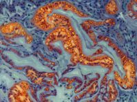 Breakthrough Discovery May Restore Chemo Response in Pancreatic Cancer