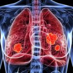 COVID or Flu Could Increase Lung Cancer Risk Years Later