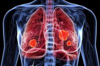 COVID or Flu Could Increase Lung Cancer Risk Years Later