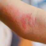 Stress Can Directly Worsen Eczema Symptoms