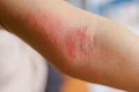 Stress Can Directly Worsen Eczema Symptoms