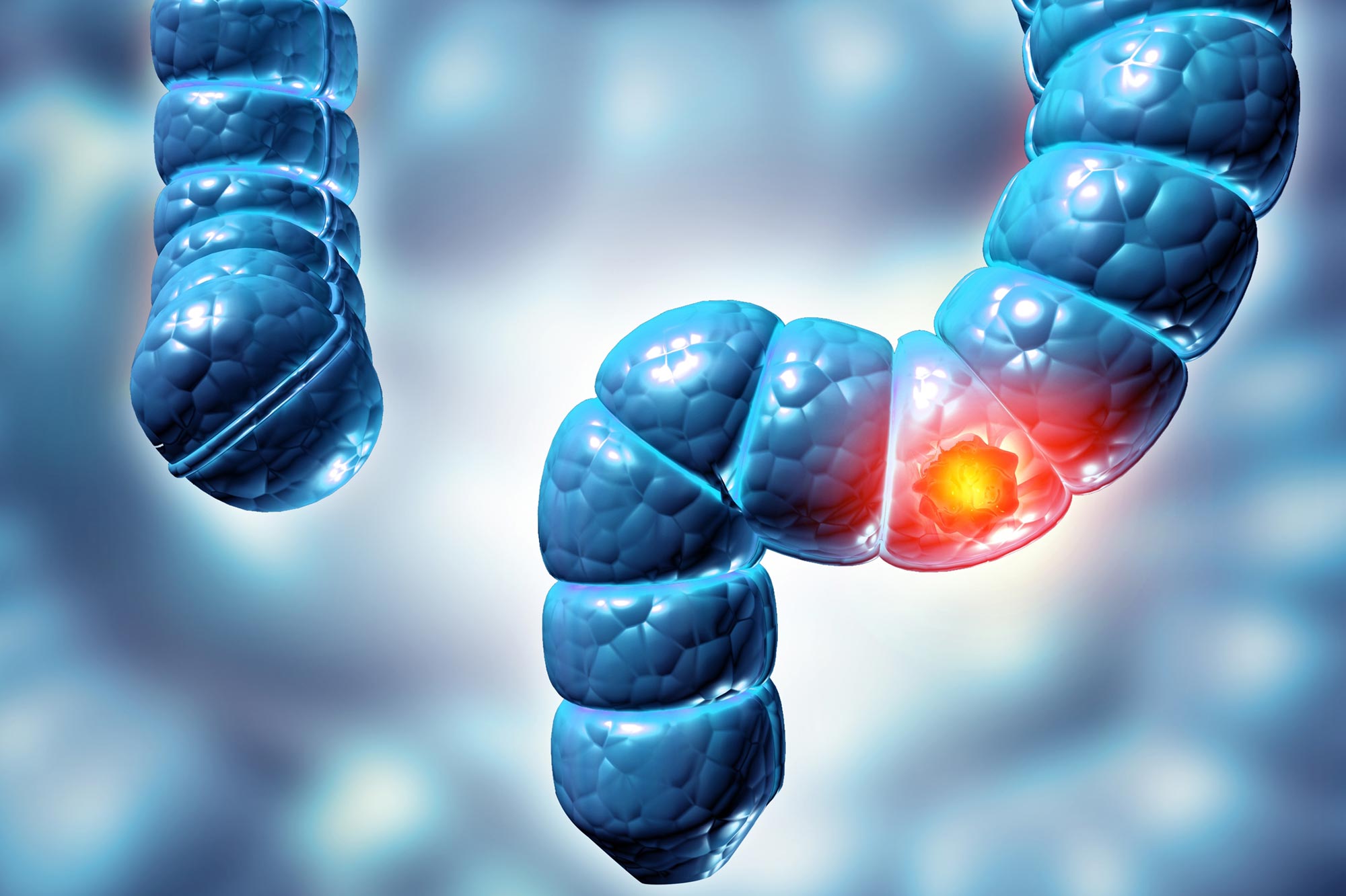 Hidden Virus Linked to Colorectal Cancer Discovered by Scientists