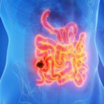 Breakthrough Bowel Cancer Trial Achieves Nearly 3 Years of Remission