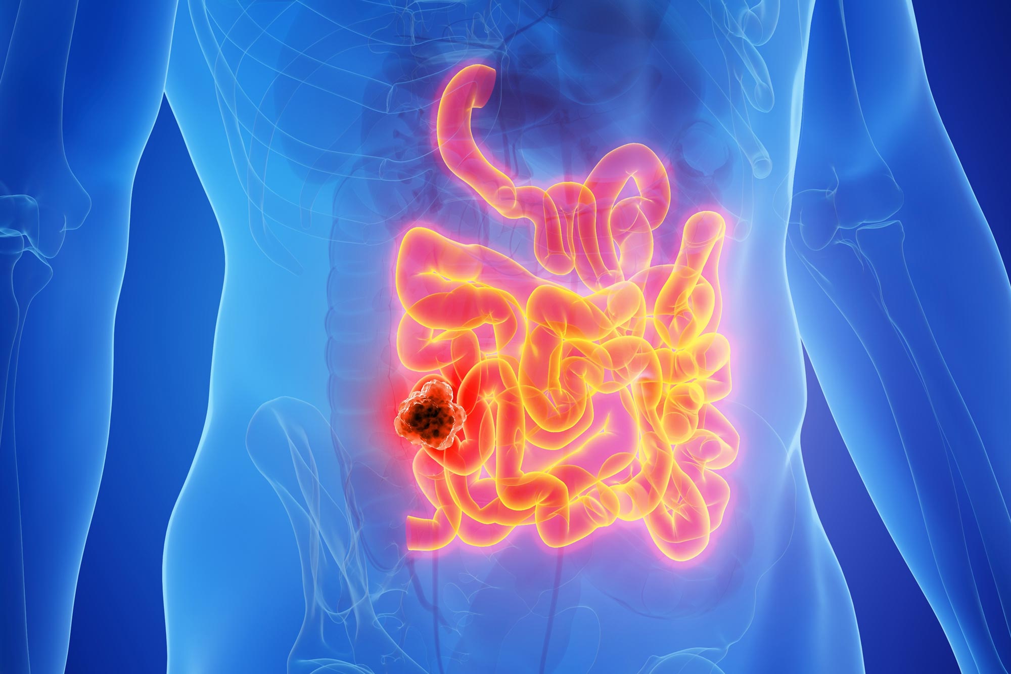 Breakthrough Bowel Cancer Trial Achieves Nearly 3 Years of Remission