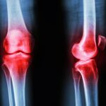 New Hormone Discovery May Transform Arthritis Treatment