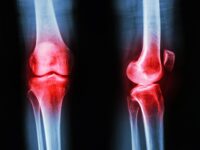New Hormone Discovery May Transform Arthritis Treatment