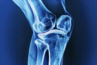 Natural Compounds Enhance Bone Implant Success and Combat Cancer