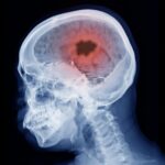 New Vitamin B12 Therapy May Transform Brain Cancer Treatment