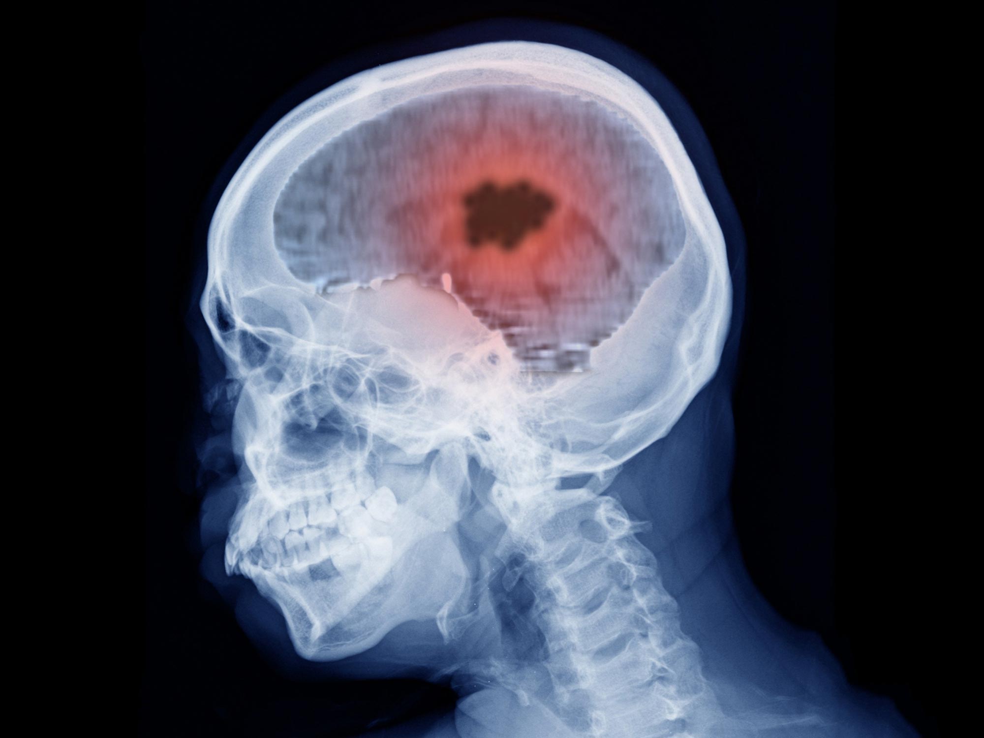 New Vitamin B12 Therapy May Transform Brain Cancer Treatment