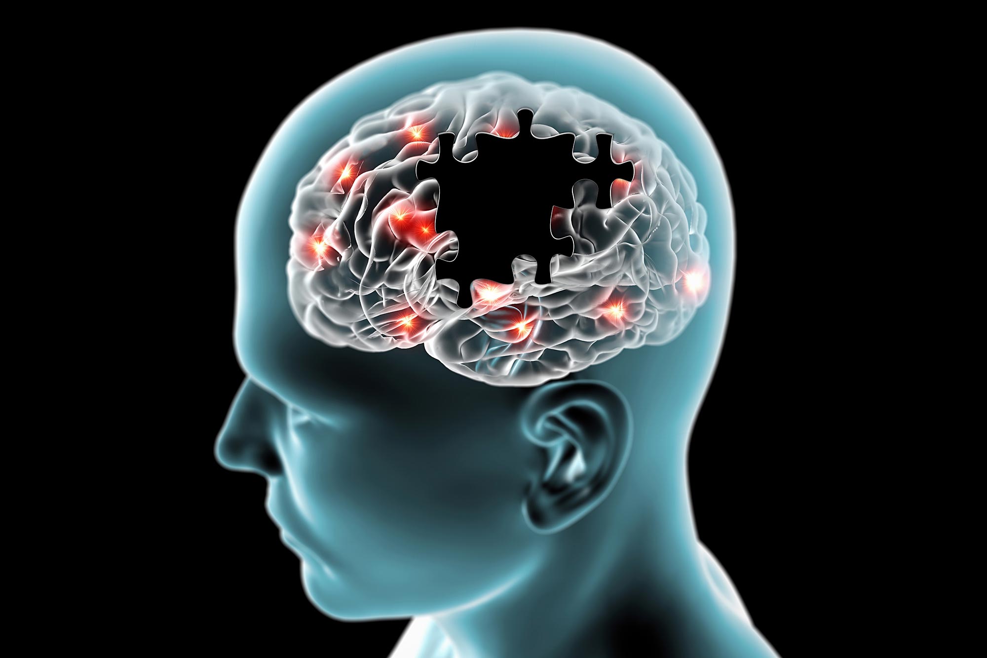 Scientists Uncover Link Between Obesity and Alzheimer’s Disease