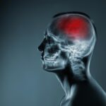 New Stroke Study Questions Longstanding Medical Beliefs