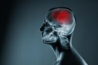 New Stroke Study Questions Longstanding Medical Beliefs