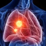 Researchers Warn: Marijuana Use May Increase Lung Cancer Risk