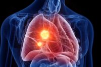 Researchers Warn: Marijuana Use May Increase Lung Cancer Risk