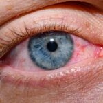 Scientists Create New Eye Drops That May Revolutionize Dry Eye Care