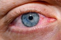 Scientists Create New Eye Drops That May Revolutionize Dry Eye Care