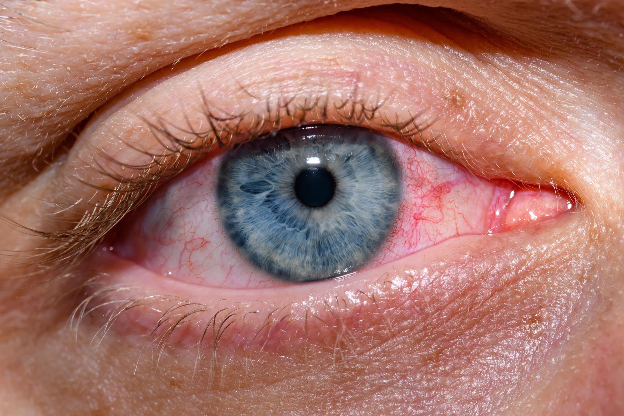 Scientists Create New Eye Drops That May Revolutionize Dry Eye Care