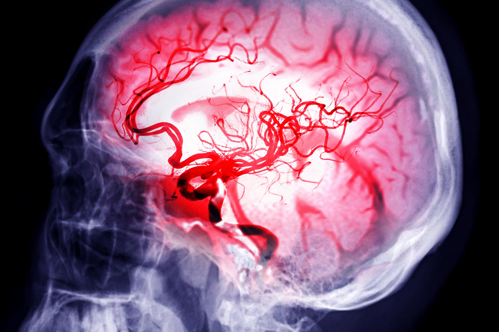 Testosterone May Help Shield Against Deadly Brain Cancer, Say Scientists
