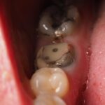 Giant Tropical Fruit May Hold Key to Dental Health Secrets