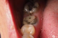 Giant Tropical Fruit May Hold Key to Dental Health Secrets