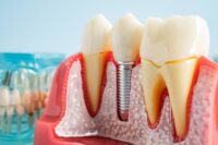 Researchers Uncover Cause of Billion-Dollar Dental Implant Disease