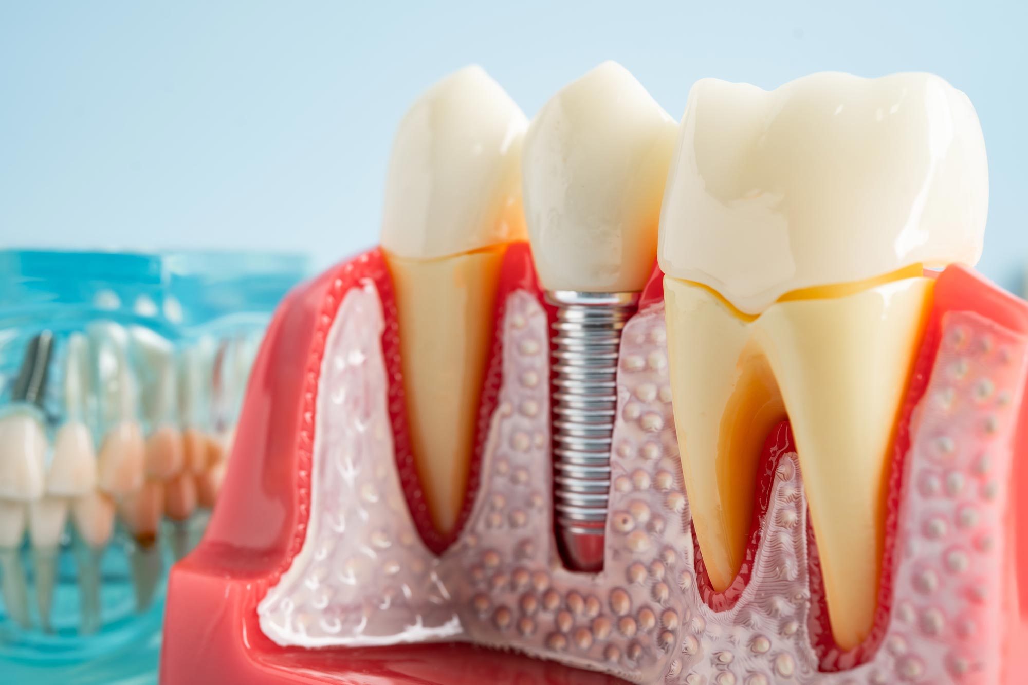 Researchers Uncover Cause of Billion-Dollar Dental Implant Disease