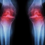 Scientists Find Ultrasound Could Prevent Arthritis Onset