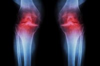 Scientists Find Ultrasound Could Prevent Arthritis Onset