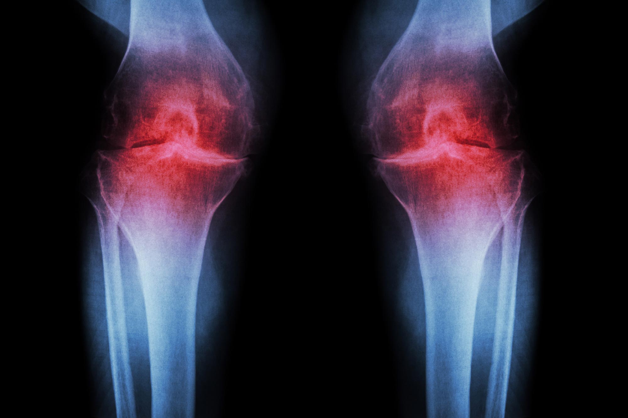 Scientists Find Ultrasound Could Prevent Arthritis Onset