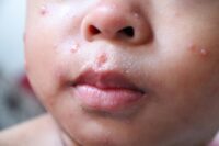 Scientists Uncover Immune Cells Targeting Measles and Nipah