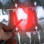 Natural Compounds Tested for Sarcoma: Which Is Most Promising?