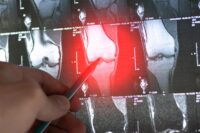 Natural Compounds Tested for Sarcoma: Which Is Most Promising?