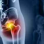 Hip Replacements Last Longer Than Previously Expected