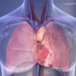Common Oral Bacteria Linked to Harmful Heart Calcium Buildup