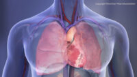 Common Oral Bacteria Linked to Harmful Heart Calcium Buildup
