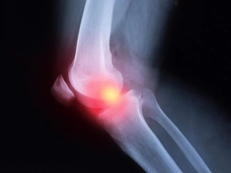 Why Arthritis May Recur More Intense After Cancer Immunotherapy