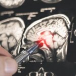 Sleep Enhances Memories, Yet Epilepsy Disrupts This Link