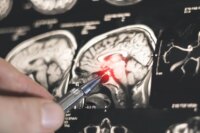 Sleep Enhances Memories, Yet Epilepsy Disrupts This Link