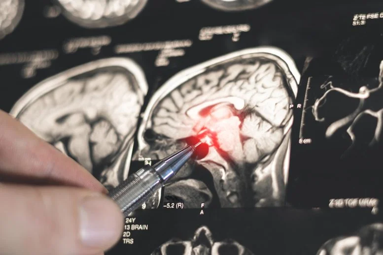 Sleep Enhances Memories, Yet Epilepsy Disrupts This Link