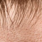 Deadly Fungus Discovers Ideal Hiding Spot: Human Hair Follicles