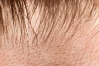Deadly Fungus Discovers Ideal Hiding Spot: Human Hair Follicles