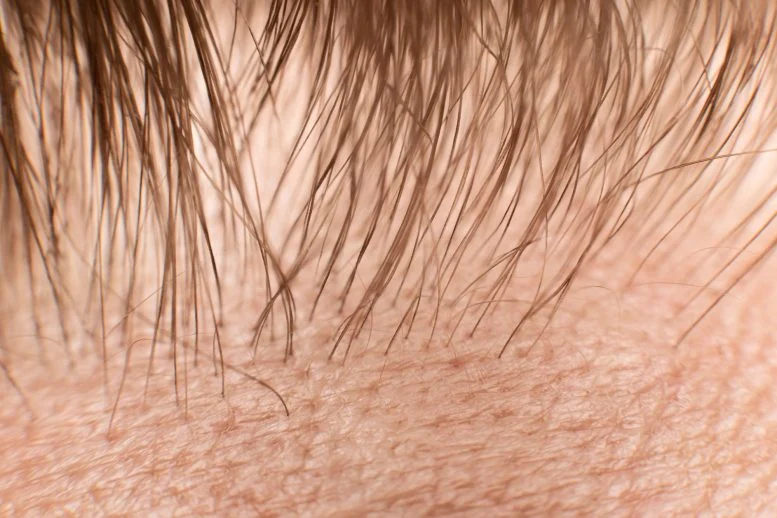 Deadly Fungus Discovers Ideal Hiding Spot: Human Hair Follicles