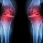 New Injectable Hydrogel May Revolutionize Osteoarthritis Care